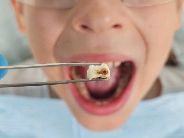 Best Dentist for Tooth Abscess  in Sturgis, KY